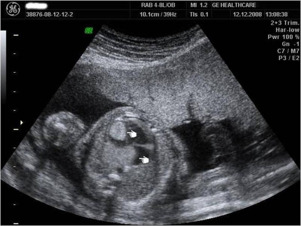 Fetal Cardiac Rhabdomyoma Fetal Cardiac Rhabdomyoma
