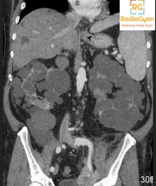 Autosomal Dominant Polycystic Kidney CT Autosomal Dominant Polycystic Kidney CT