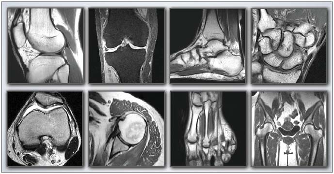 Lady Windermere Syndrome Radiology Features And Differtial Diagnosis