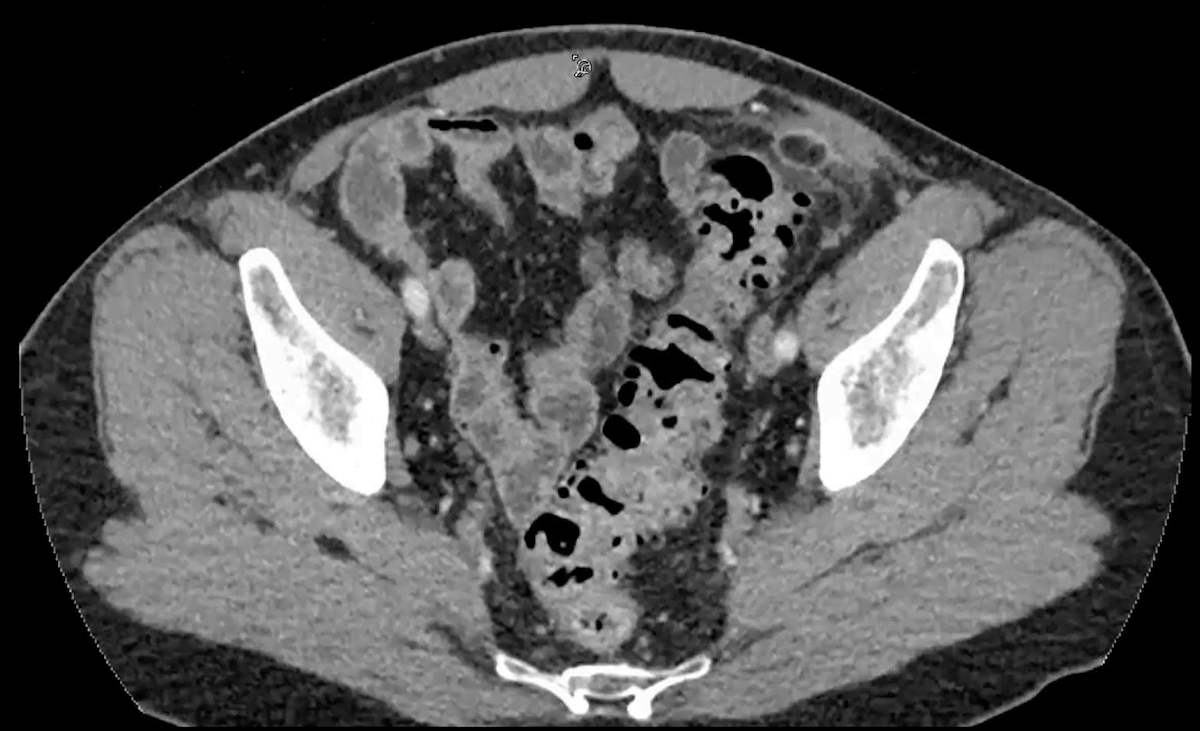 Lady Windermere Syndrome Radiology Features And Differtial Diagnosis