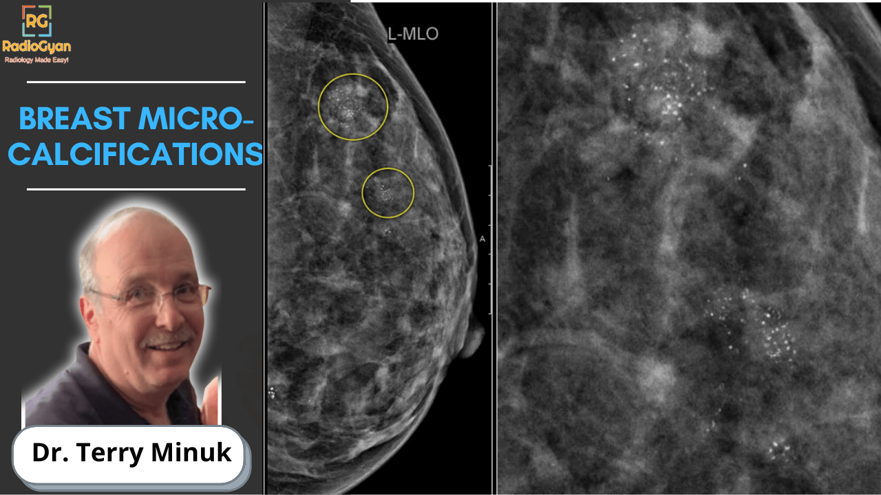 Breast Microcalcifications | Mammography | Dr. Terry Minuk | RadioGyan